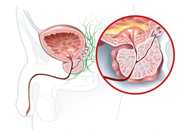 Symptome einer Prostatitis