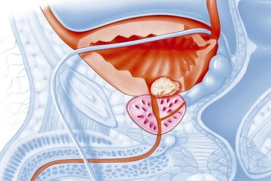 Entzündlicher Prozess der Prostata