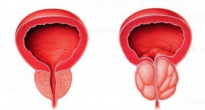 gesunde und entzündete Prostata mit chronischer Prostatitis