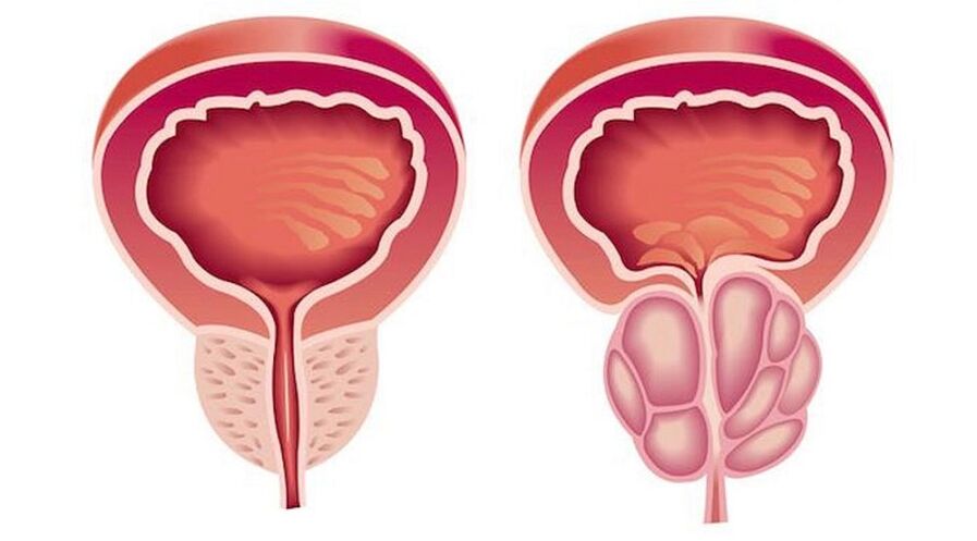 Gesunde Prostata und mit Prostatitis entzündet