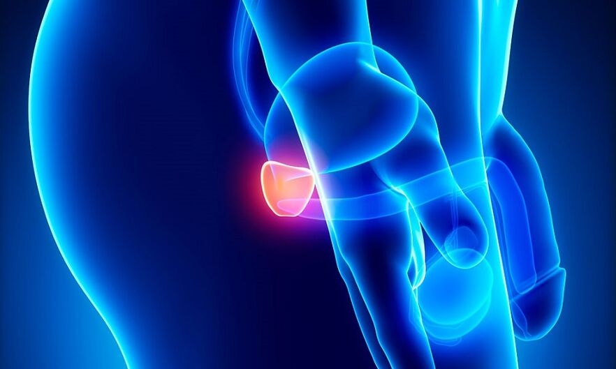 Prostata -Entzündung mit Prostatitis