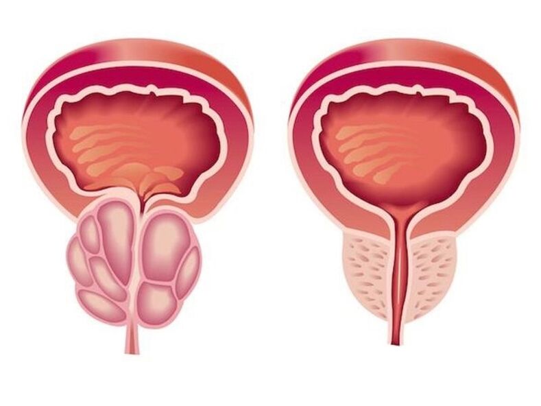 Was für eine Prostatitis tut